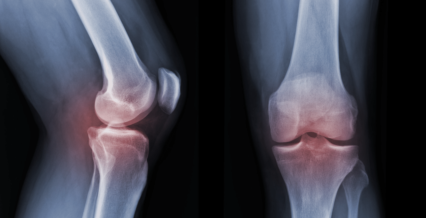 X-ray of both knees (front and side views) with red shading around the joints to indicate inflammation or pain.