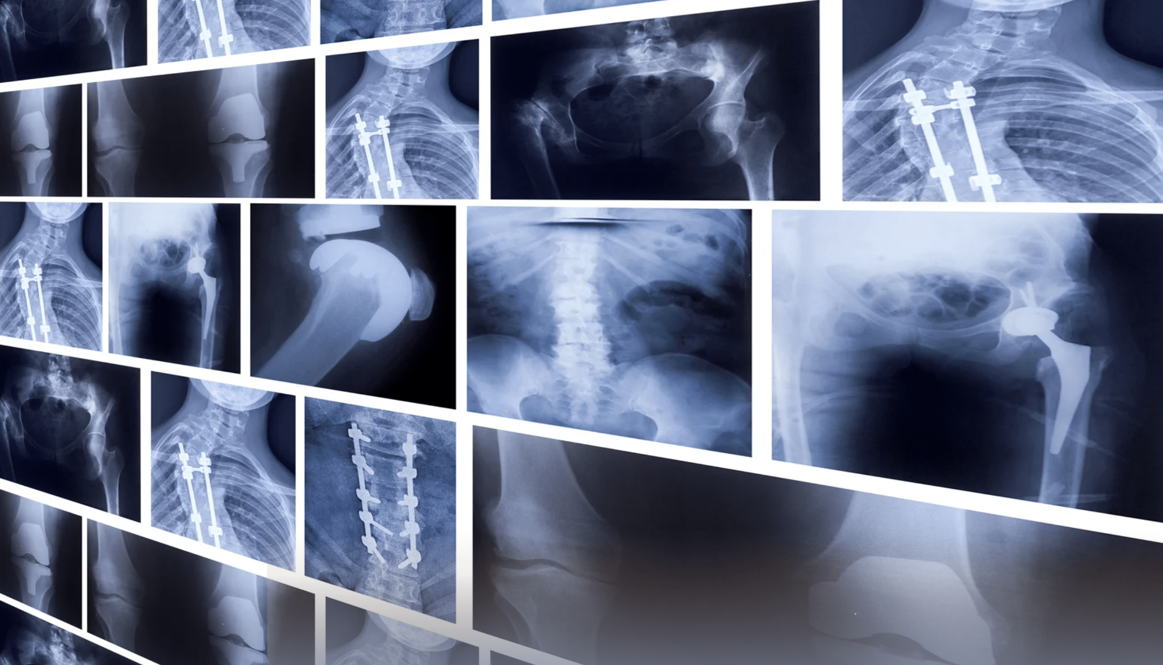 Composite X-ray montage showing multiple views of bones with surgical hardware (rods, screws, and prostheses).