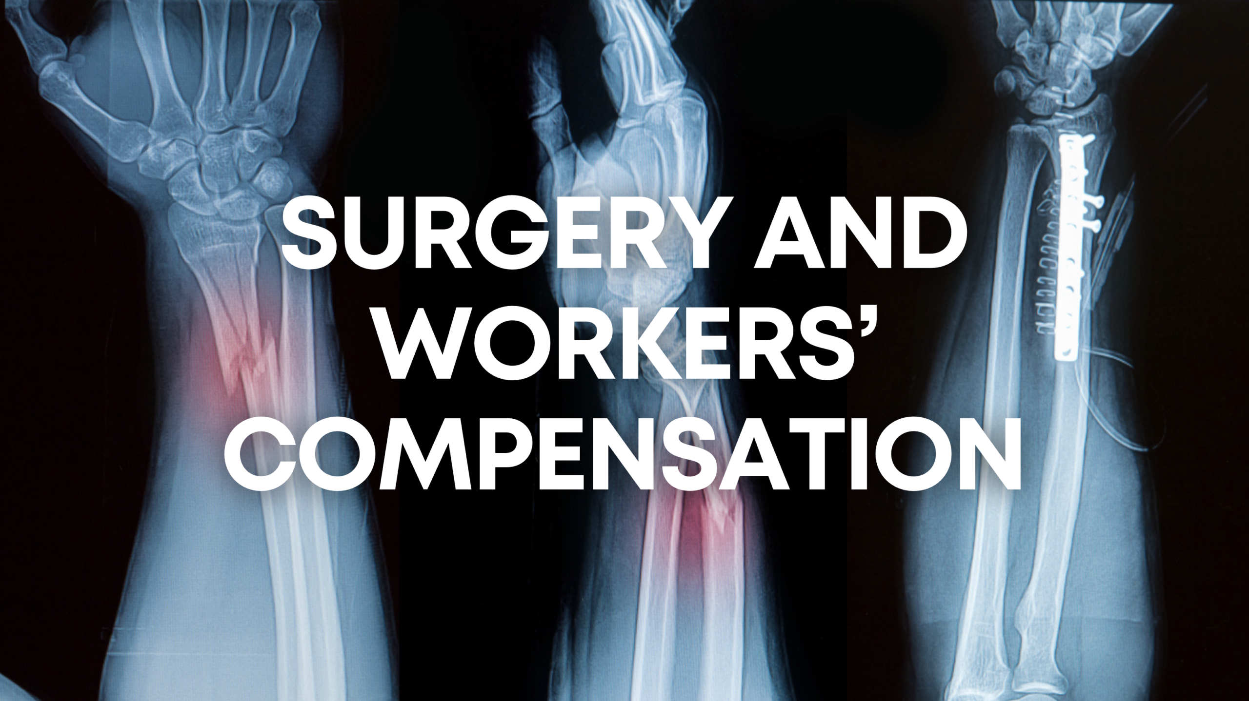 surgery workers comp